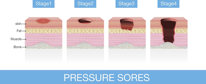 Stages of Pressure ulcers